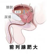 前列腺肥大检查