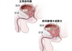 治疗前列腺肥大需要多少钱